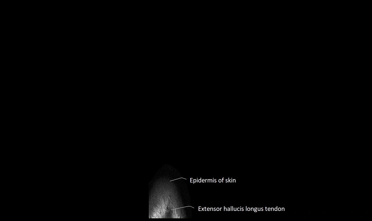 Great Toe micro anatomy MRI axial cross sectional 3T image 1.webp